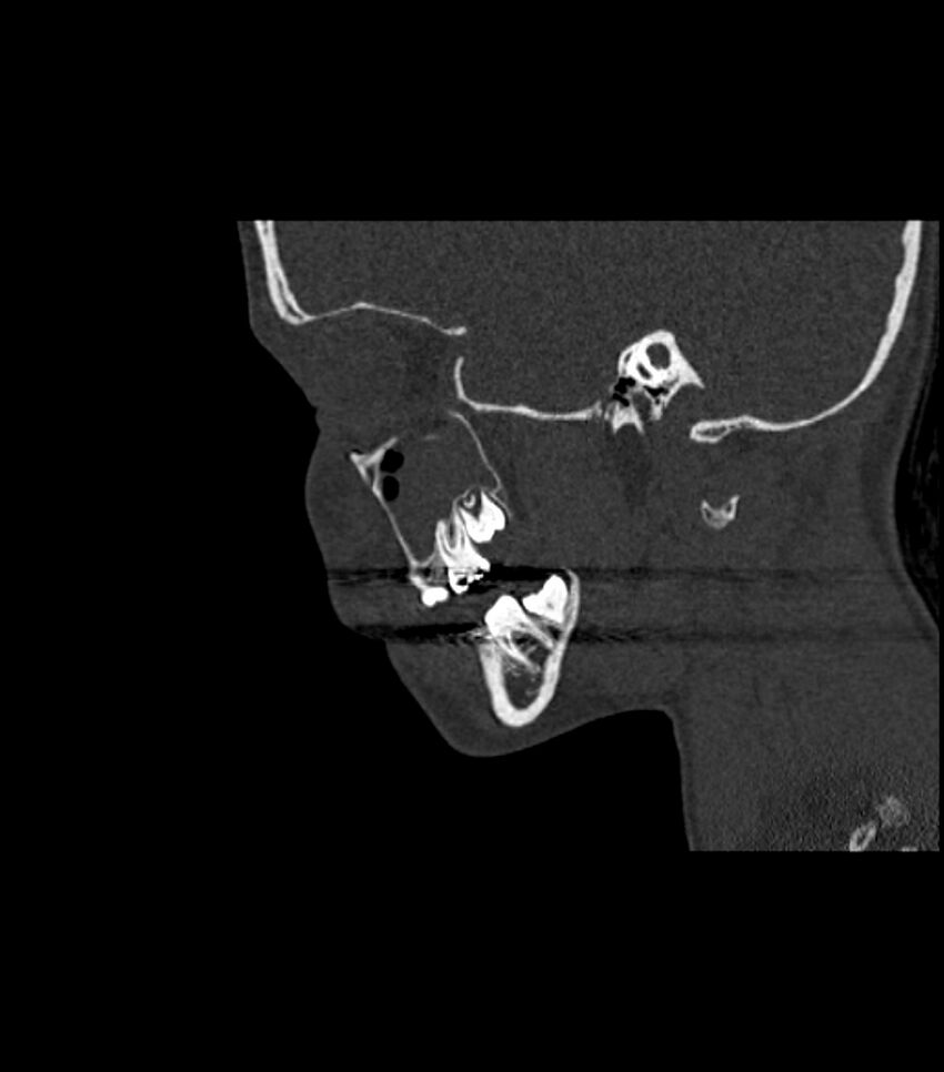 Nasoorbitoethmoid fracture (Radiopaedia 90044-107205 Sagittal bone window 100).jpg