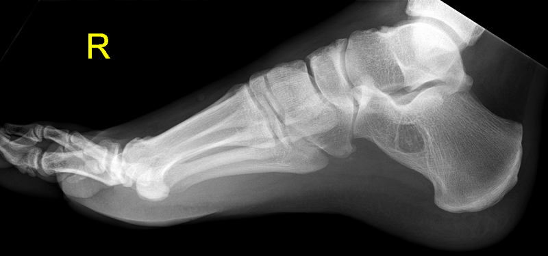 File:Navicular fracture (Radiopaedia 31710-32632 Lateral 1).png
