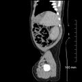Neonatal neuroblastoma (Radiopaedia 56651-63438 C 21).jpg