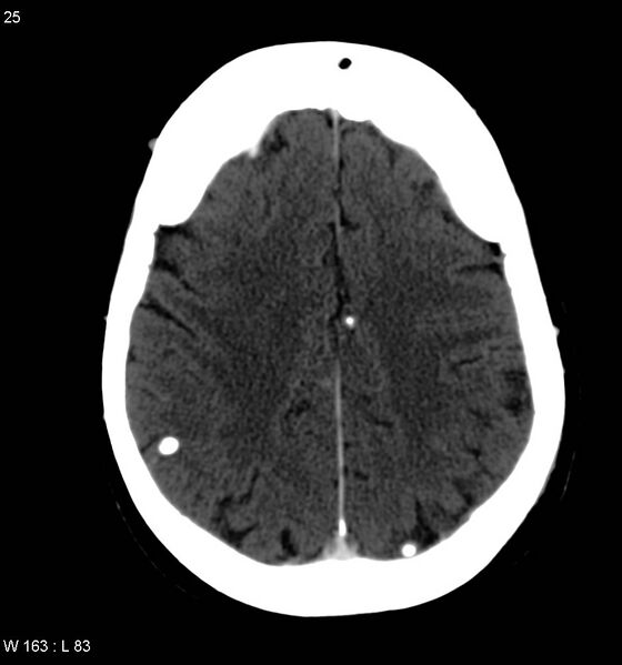 File:Neurocysticercosis (Radiopaedia 7773-8596 C+ delayed 13).jpg