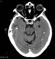 Neurocysticercosis (Radiopaedia 7773-8596 non-contrast 2).jpg