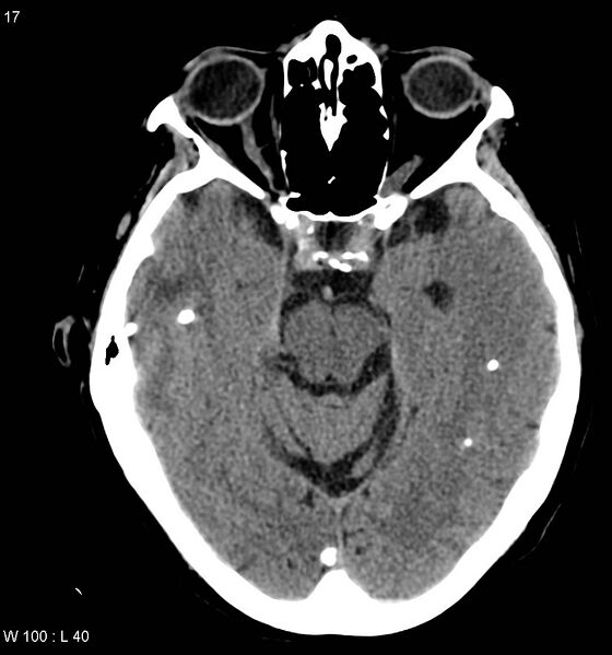 File:Neurocysticercosis (Radiopaedia 7773-8596 non-contrast 2).jpg