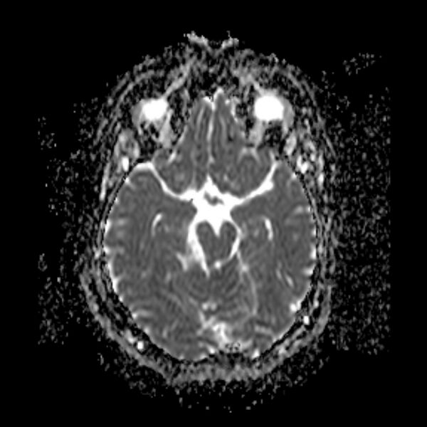 File:Neurofibromatosis type 2 (Radiopaedia 67470-76871 Axial ADC 9).jpg