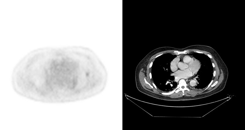 File:Non-Hodgkin lymphoma involving seminal vesicles with development of interstitial pneumonitis during Rituximab therapy (Radiopaedia 32703-33675 axial PET CT 45).jpg