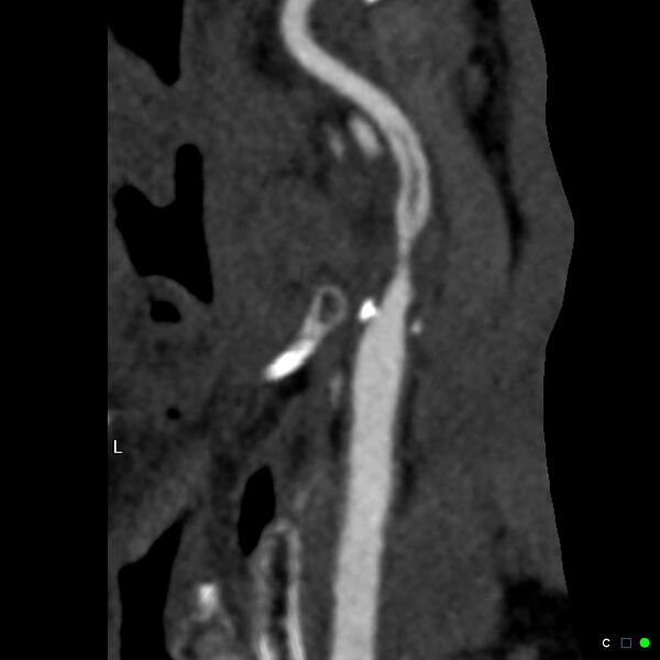 File:Non-occlusive intraluminal internal carotid artery thrombus (Radiopaedia 37751-39658 A 43).jpg