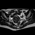 Non-puerperal uterine inversion (Radiopaedia 78343-90983 Axial T2 23).jpg