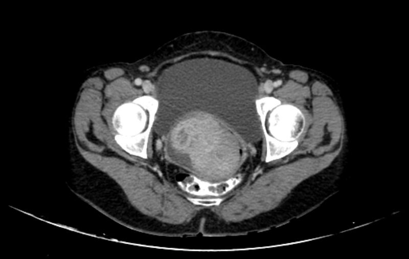 File:Non-puerperal uterine inversion (Radiopaedia 78343-91094 A 56).jpg