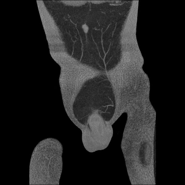 File:Normal CT angiogram of pelvis (Radiopaedia 45390-49430 B 9).jpg