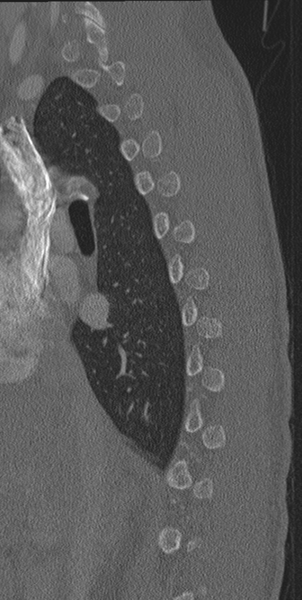 File:Normal CT thoracic spine (Radiopaedia 40181-42688 Sagittal bone window 49).png