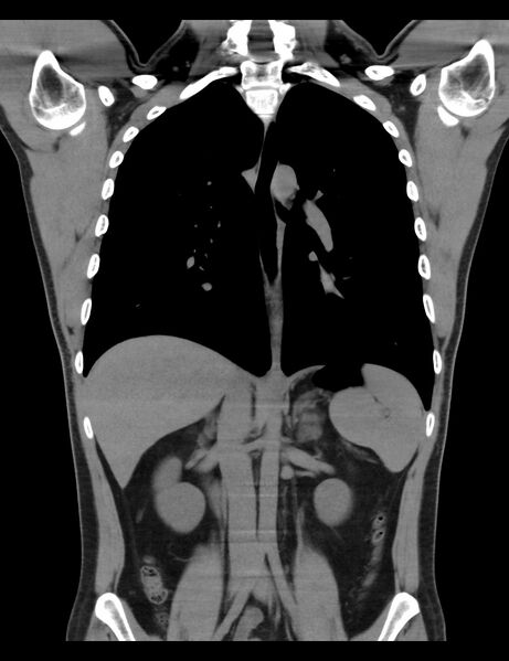 File:Normal CT virtual gastroscopy (Radiopaedia 29960-30501 E 3).jpg