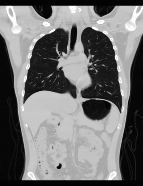 File:Normal CT virtual gastroscopy (Radiopaedia 29960-30501 F 7).jpg