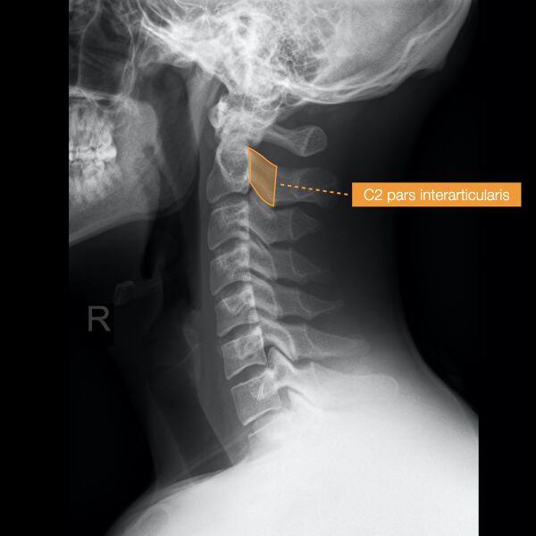 File:Normal cervical spine radiographs (Radiopaedia 32505-96697 A 7).jpeg