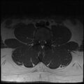 Normal lumbar spine MRI (Radiopaedia 47857-52609 Axial T1 11).jpg