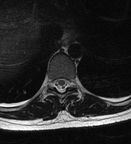 File:Normal thoracic spine MRI (Radiopaedia 41033-43781 Axial T2 12).jpg