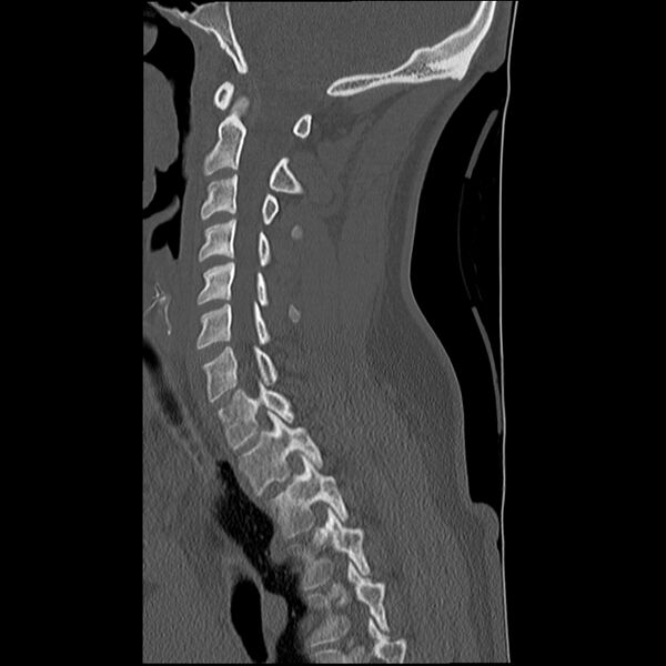 File:Normal trauma spine imaging (Radiopaedia 31753-32686 Sagittal bone window 16).jpg