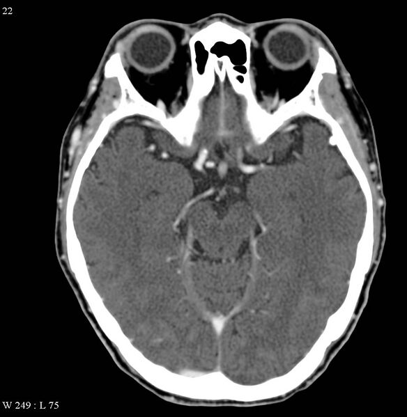 File:Occipital condyle metastasis - into mastoid (Radiopaedia 5424-7177 B 16).jpg