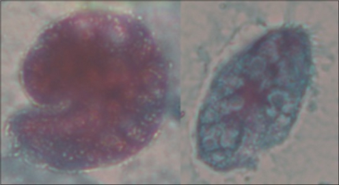 Trichrome stained trophozoites of Balantidium coli