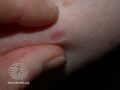 Pinch sign of dermatofibroma (DermNet NZ lesions-df4).jpg