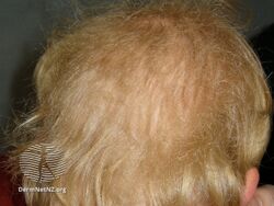 Woolly hair naevus (DermNet NZ hair-nails-sweat-woolly-hair-naevus2).jpg