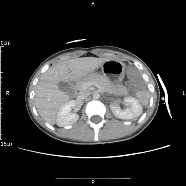 File:AAST grade IV kidney injury with CEUS follow-up (Radiopaedia 72353-82877 Axial C+ portal venous phase 21).jpg