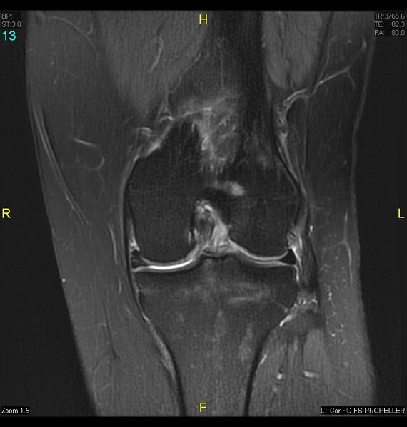 File:ACL mucoid degeration with cystic changes (Radiopaedia 48428-53341 Coronal PD fat sat 10).jpg