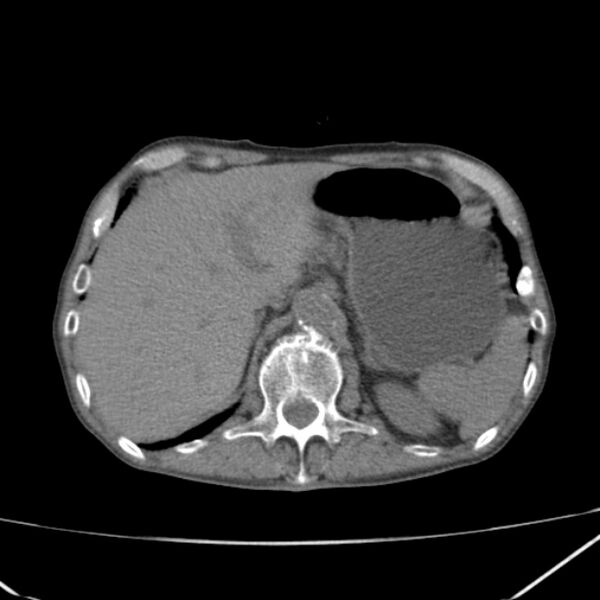 File:Abdominal aortic aneurysm (Radiopaedia 23703-23856 Axial non-contrast 12).jpg