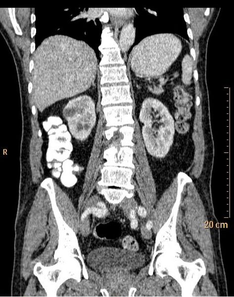 File:Abdominal aortic aneurysm (Radiopaedia 25985-26121 Coronal C+ arterial phase 24).jpg
