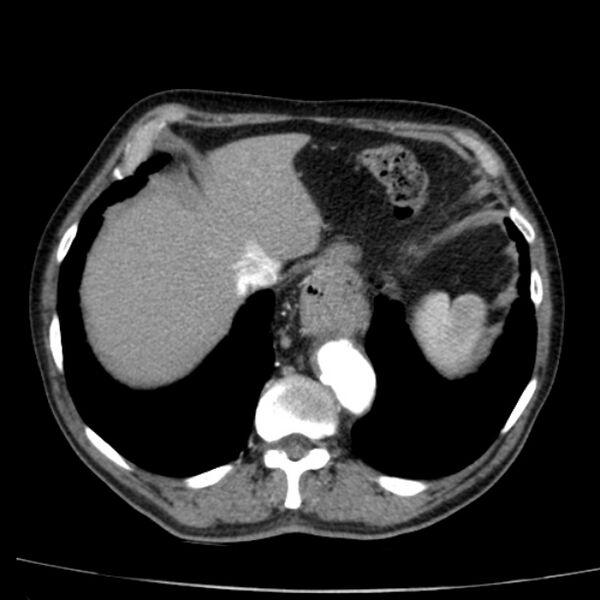 File:Abdominal aortic aneurysm (Radiopaedia 29248-29660 Axial C+ arterial phase 10).jpg