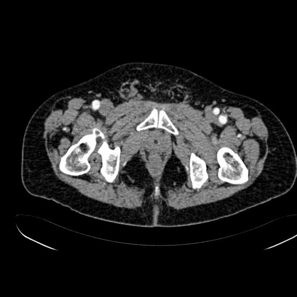 File:Abdominal aortic aneurysm (Radiopaedia 75131-86203 Axial C+ arterial phase 48).jpg