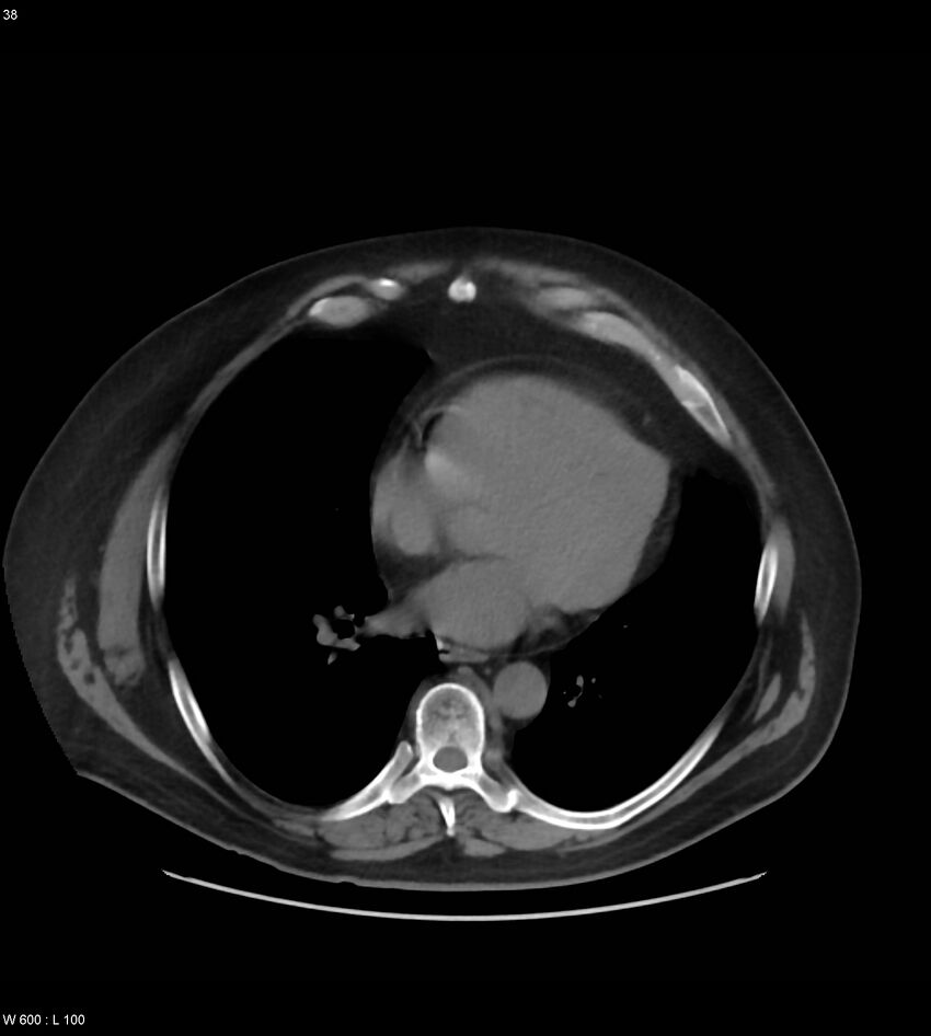 Abdominal aortic aneurysm with intramural hematoma then rupture (Radiopaedia 50278-55631 Axial non-contrast 34).jpg
