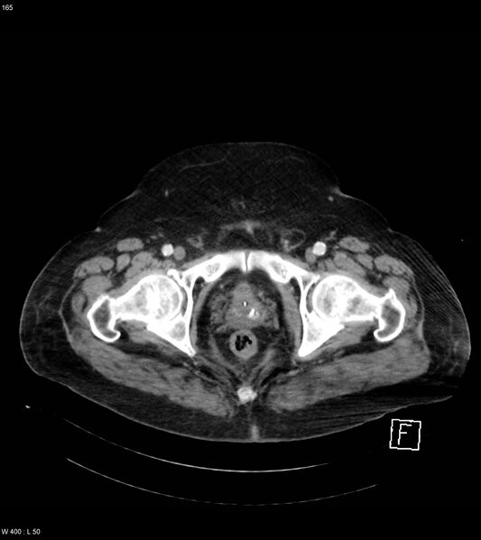 File:Abdominal aortic aneurysm with intramural hematoma then rupture (Radiopaedia 50278-55632 Axial C+ arterial phase 164).jpg