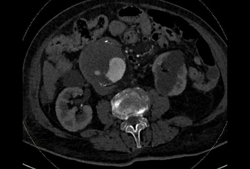 File:Abdominal aortic aneurysm with thrombus fissuration (Radiopaedia 73192-83919 Axial C+ arterial phase 101).jpg