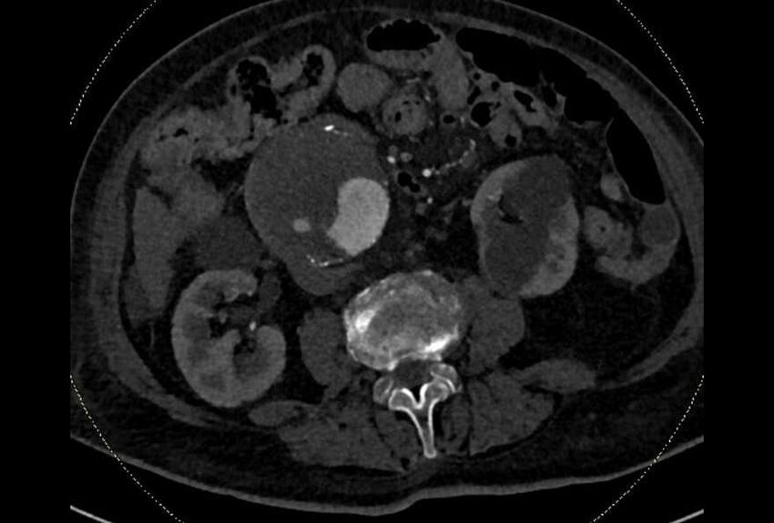 Abdominal aortic aneurysm with thrombus fissuration (Radiopaedia 73192-83919 Axial C+ arterial phase 101).jpg