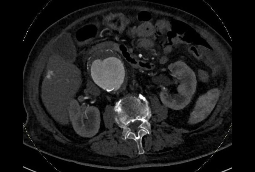 Abdominal aortic aneurysm with thrombus fissuration (Radiopaedia 73192-83919 Axial C+ arterial phase 71).jpg