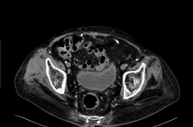 File:Abdominal aortic interposition tube graft and aneurysm thrombosis (Radiopaedia 71438-81857 Axial C+ arterial phase 206).jpg