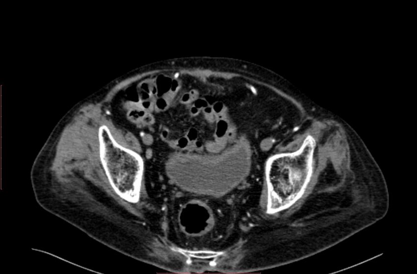 Abdominal aortic interposition tube graft and aneurysm thrombosis (Radiopaedia 71438-81857 Axial C+ arterial phase 206).jpg