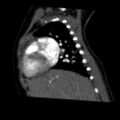 Aberrant left pulmonary artery (pulmonary sling) (Radiopaedia 42323-45435 Sagittal C+ arterial phase 16).jpg