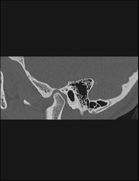 File:Aberrant right internal carotid artery (Radiopaedia 65191-74198 Sagittal non-contrast 35).jpg