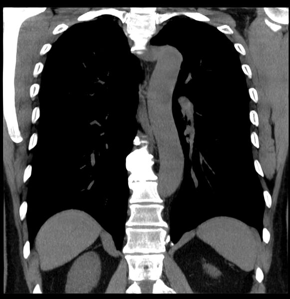 File:Aberrant right subclavian artery (Radiopaedia 40967-43680 Coronal non-contrast 26).jpg