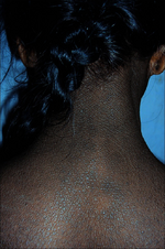 Acanthosis nigricans neck.png