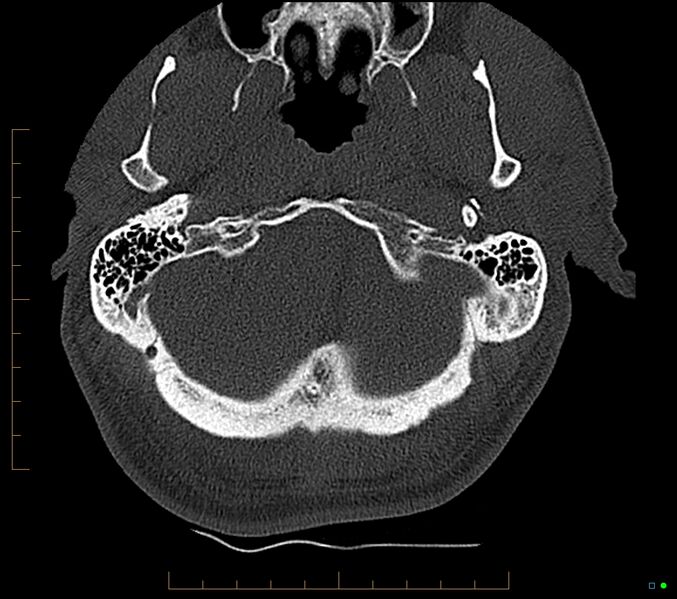 File:Accessory articulation of cervical transverse processes (Radiopaedia 82715-96933 Axial non-contrast 2).jpg