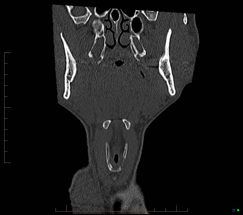 Accessory articulation of cervical transverse processes (Radiopaedia 82715-96933 Coronal non-contrast 14).jpg