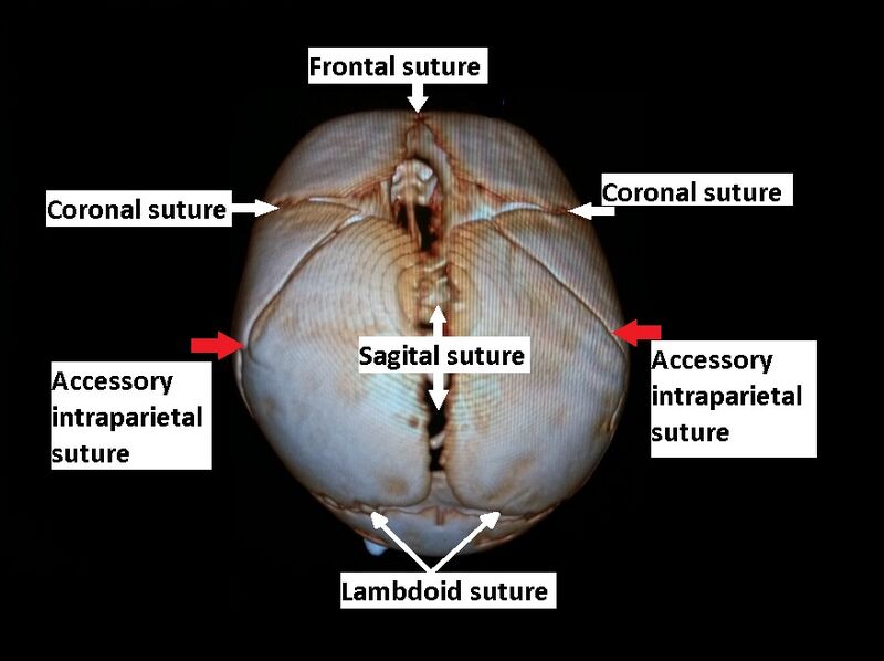 File:Accessory intraparietal suture (Radiopaedia 50584-56021 3D reconstruction 9).jpg