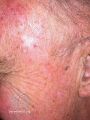 Actinic Keratoses treated with imiquimod (DermNet NZ lesions-ak-imiquimod-3764).jpg
