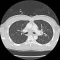 Active right ventricular cardiac sarcoidosis (Radiopaedia 55596-62101 Axial lung window 16).jpg