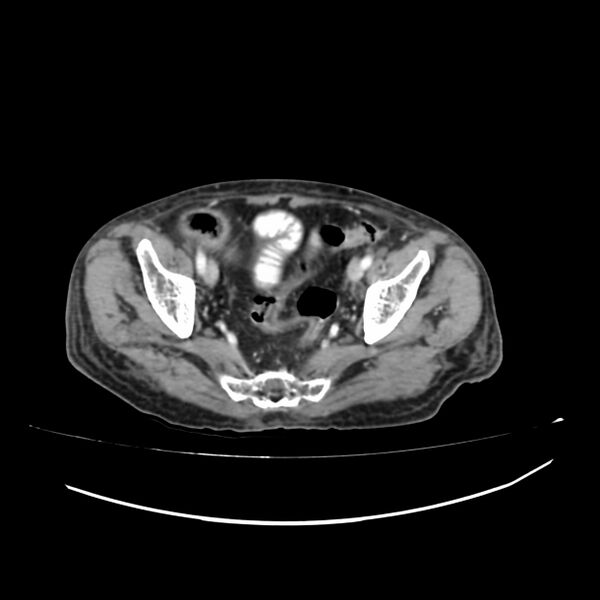 File:Acute-on-chronic Crohn disease with enteroenteric fistula (Radiopaedia 66686-75987 B 66).jpg