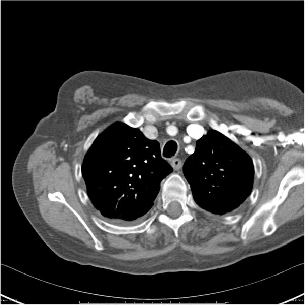 File:Acute-on-chronic pulmonary emboli (Radiopaedia 27925-28169 C+ CTPA 15).jpg