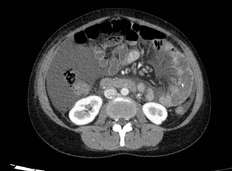 File:Acute Budd-Chiari syndrome (Radiopaedia 60858-68638 Axial C+ portal venous phase 151).jpg