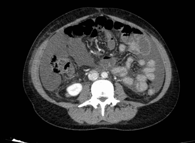 File:Acute Budd-Chiari syndrome (Radiopaedia 60858-68638 Axial C+ portal venous phase 165).jpg