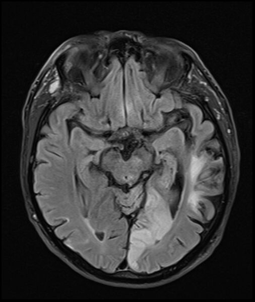 File:Acute P1 occlusion with PCA ischemia penumbra (CT perfusion) (Radiopaedia 72084-82590 Axial FLAIR 15).jpg